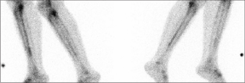 medial tibial stress syndrome bone scan