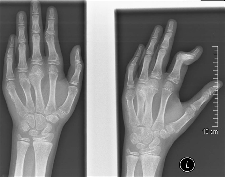 Atypical presentation of hereditary multiple osteochondromas: Thirteen ...