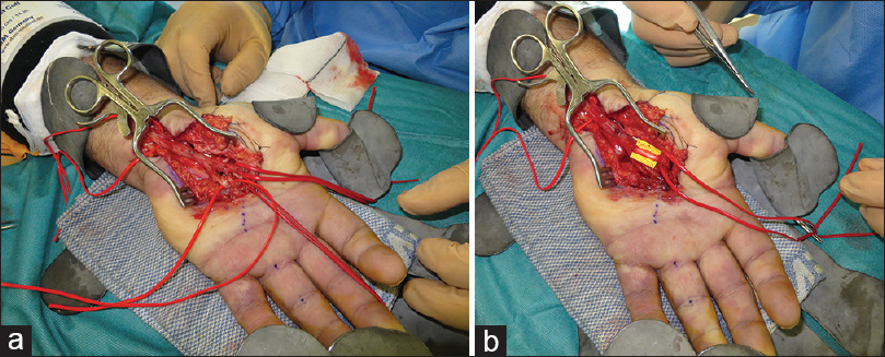 Carpal Tunnel decompression: Extended approach Surgical Technique