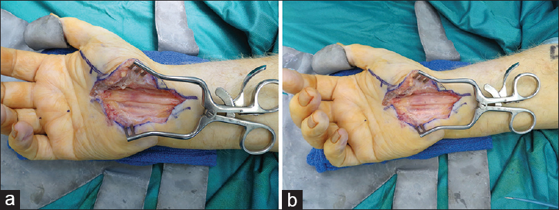 Open Carpal Tunnel Surgery