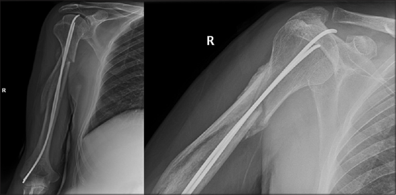 Spiral Humeral Shaft Fracture