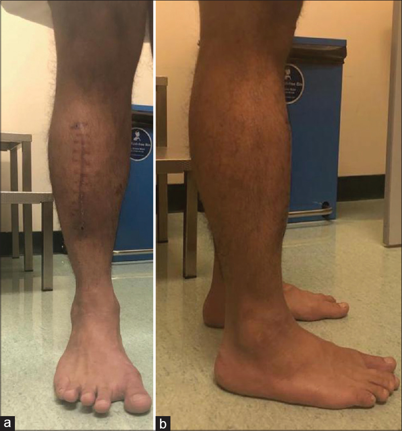 Figure From Repair Of Tibialis Anterior Muscle Herniation Using My Xxx Hot Girl