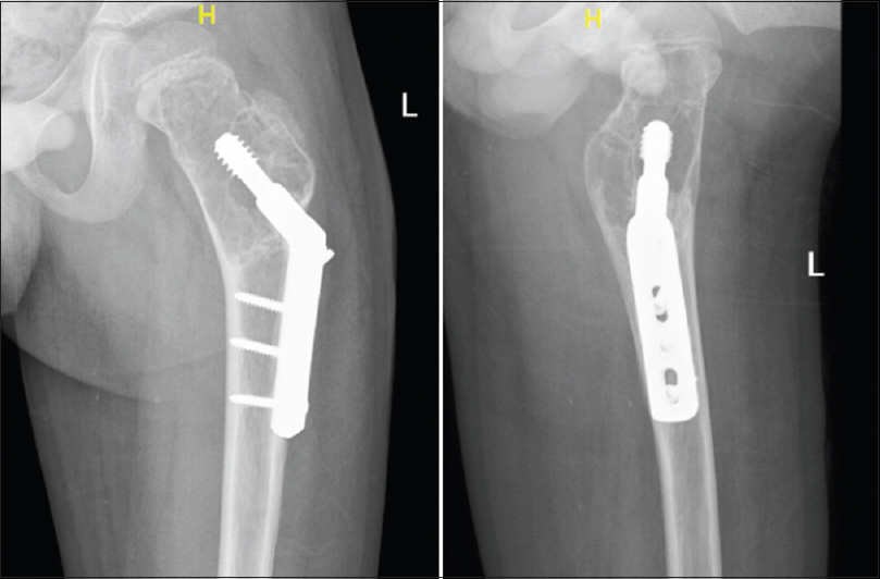 Wagner Technique For The Treatment Of Recurrent Femoral Neck Active