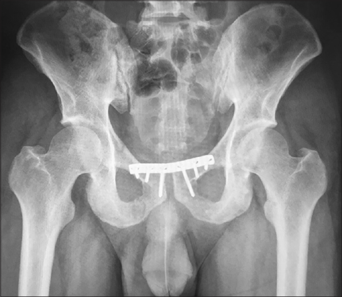 Epidemiology of surgically treated pelvis and acetabulum fractures in a ...