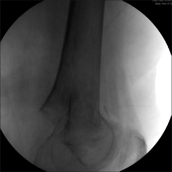 supracondylar fracture femur