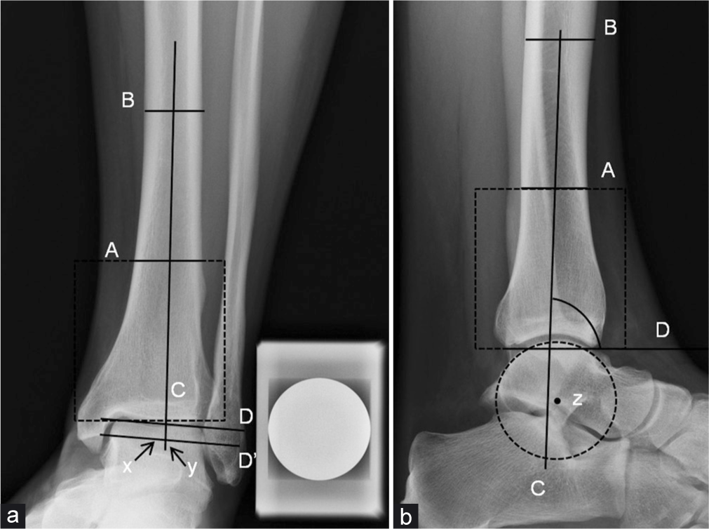 Radiographic measurements. (a) Coronal talar shift. (b) Sagittal talar shift. corTS: Lines A, B, C, and D are drawn as described in Sommer et al.[16] Line D’ is parallel and 5 mm distal to Line D. Point y is defined as the intersection between line C and line D’, and point x is the center of line D’ (projected on talus). The distance in mm between x and y is designated as talar shift; a positive coronal talar shift is when x is medial to y and a negative coronal talar shift is when x is lateral to y. (a) sagTS: Lines A, B, C, and D are drawn as described in Sommer et al.[16] Point z is the center of the talus, defined as the center of the circle that best fit the shape of the talar dome. The distance between point z and line C measures the sagittal talar shift: When z is anterior to line C, it is designated as positive sagittal talar shift; when z is posterior to C, negative sagittal talar shift (b).