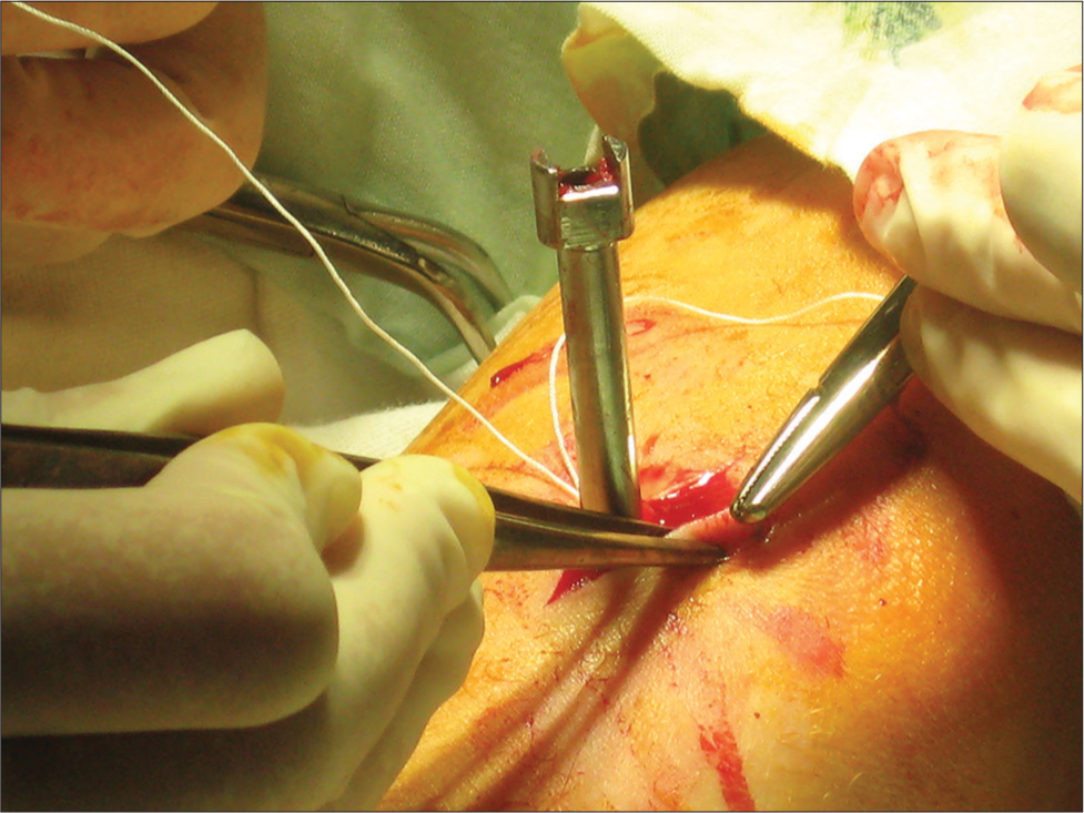 Inserting an instrument into the bone.