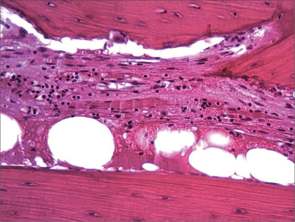 Bone marrow edema and leukocyte infiltration. Light microscopy. Hematoxylin and eosin staining. Magnification ×100.