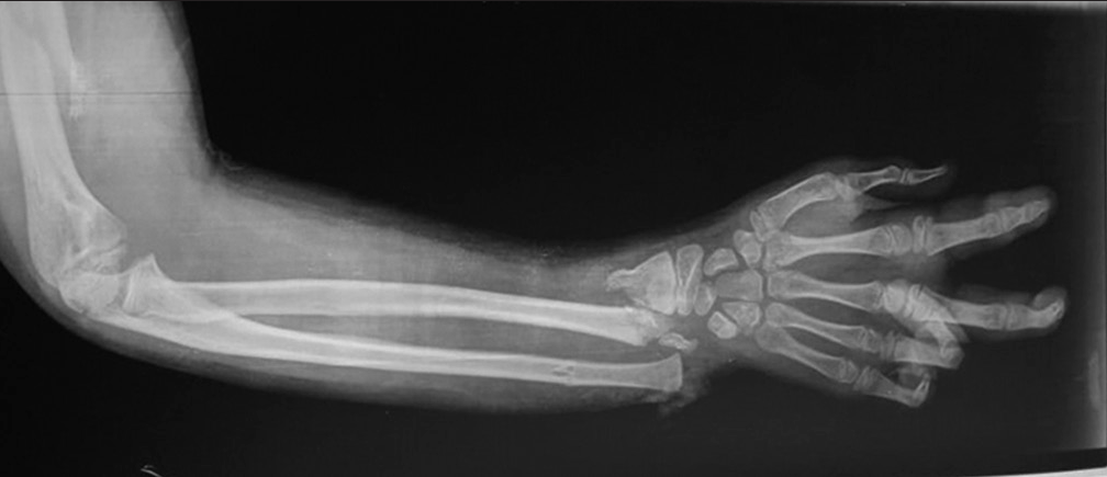 Case 11. Serious injury consisting of metaphyseal fracture of the radius and segmental ulnar fracture with physeal displacement of the distal ulna. Spin cycle rotatory injury.
