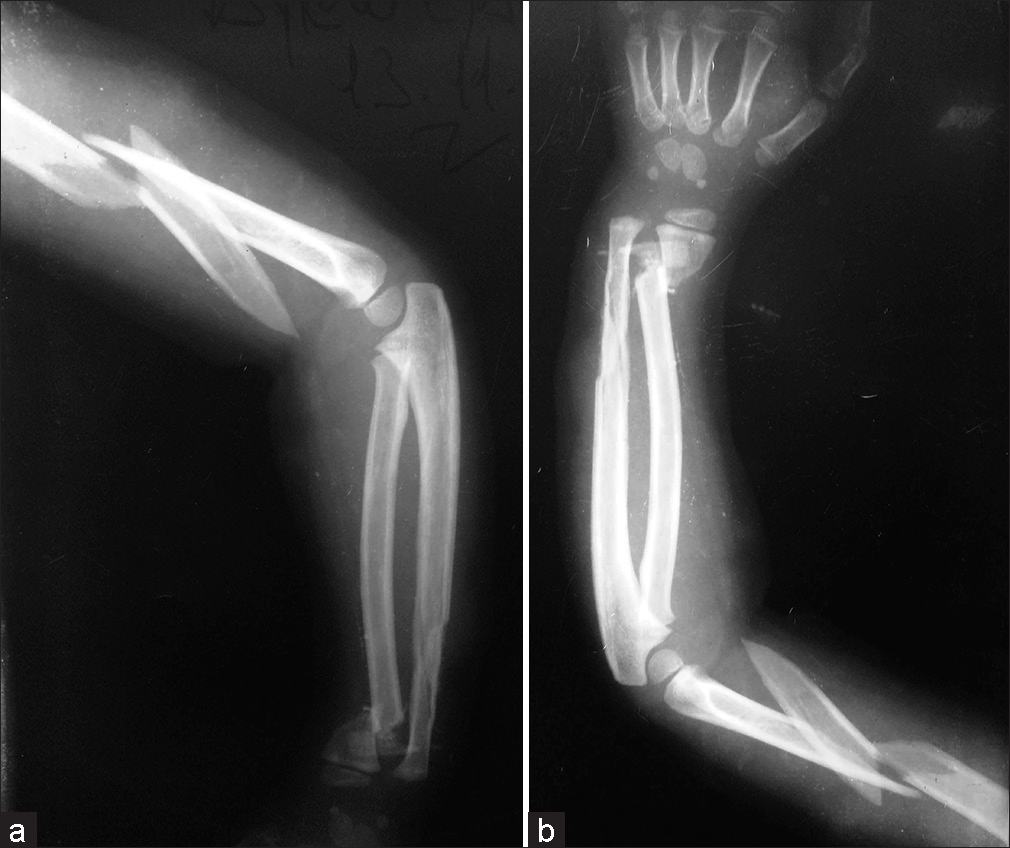 (a and b) Case 2. Spin cycle rotatory injury. Atypical fracture pattern. Anteroposterior and profile views.