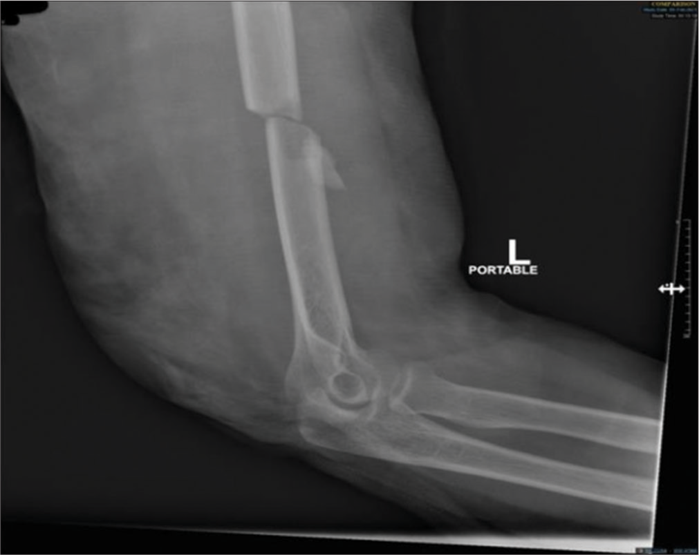 Radiograph after the trauma event. Showing a mid shaft humerus fracture.