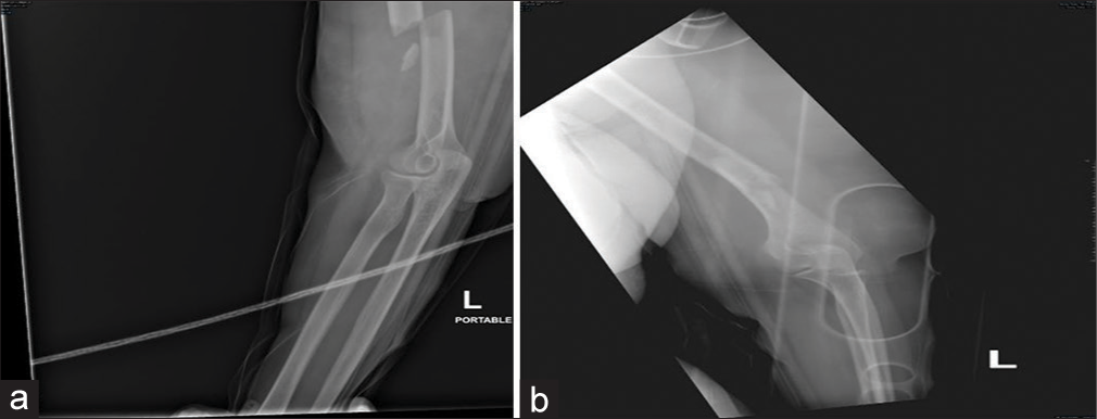 (a and b) radiograph after realignment and applying the U-shape back slab.