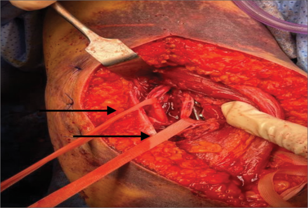 Vessel loops around the radial nerve branches after fixation of the fracture. Vessel loops are pointed at by the arrows.