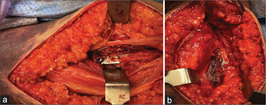 (a) Intraoperative picture showing plate insertion, (b) Intraoperative picture showing the fracture of the humerus.