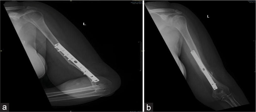 (a and b) Post-operative radiograph.