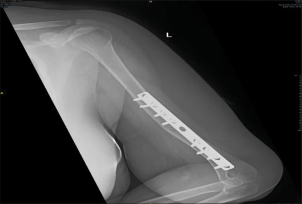 Radiograph at 6 months after surgery.