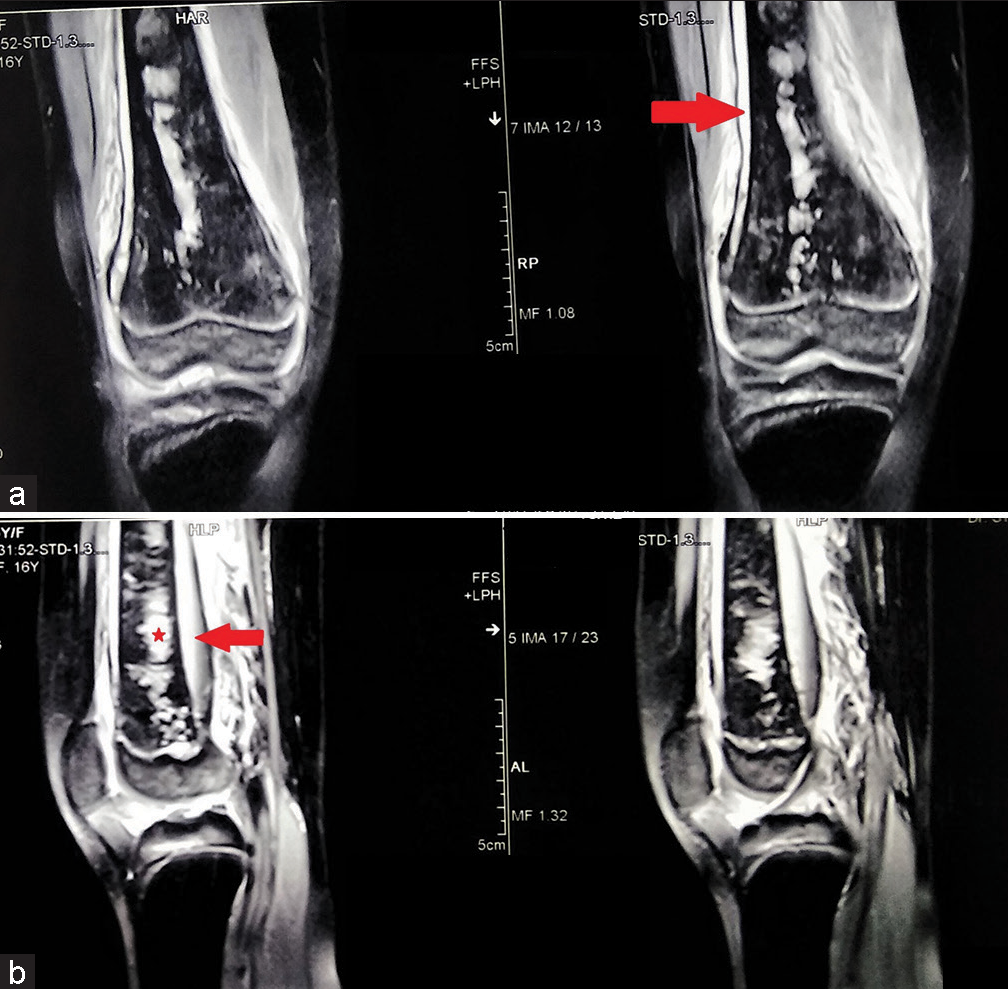 The magnetic resonance imaging coronal images show the hyperintense collection in the subperiosteal region (red arrow) extending from the distal femoral physis to the proximal diaphysis (a). The collection is large and more pronounced (red arrow) posterior to the distal femur (b). There are areas of medullary infarcts (denoted by a red star) involving the meta-diaphysial region.