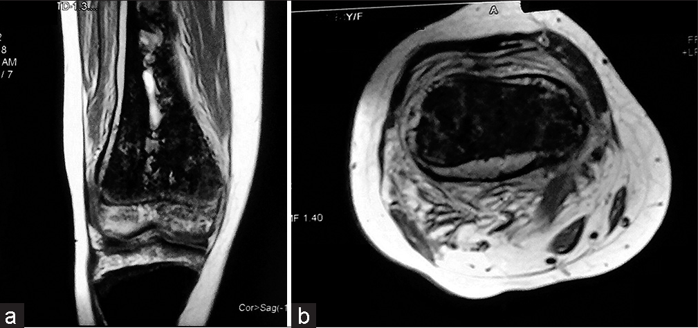 The magnetic resonance imaging coronal T1-weighted (a) and axial (b) images show hyperintense collection in the subperiosteal region and areas of increased intensity within medullary infarcts.