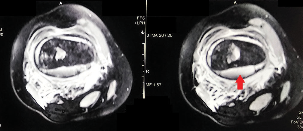 The magnetic resonance imaging axial fat-suppressed sections show the more posterior collection (red arrow) surrounding the bone.