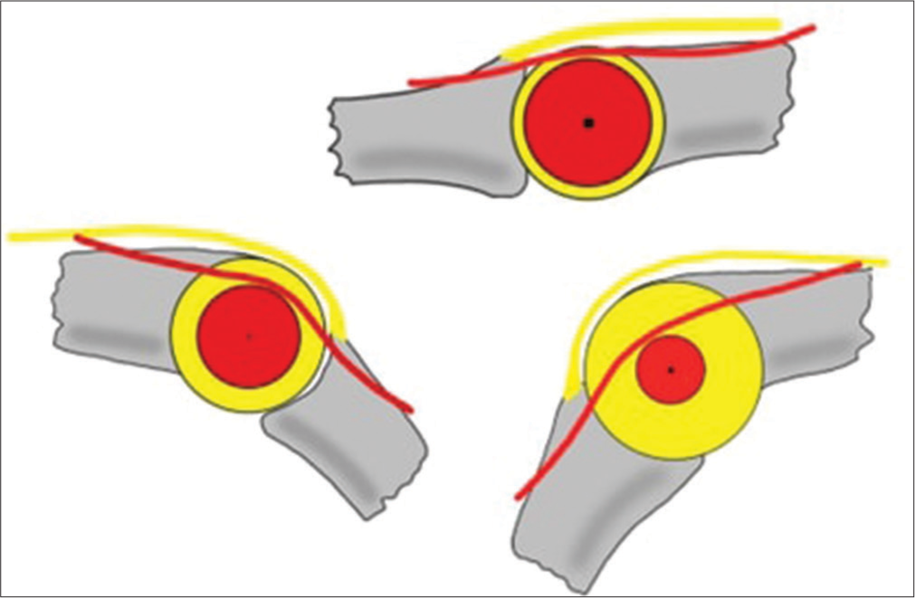 Top view of the forces exerted by the lateral and central bands on a simulated proximal interphalangeal joint, illustrating the distribution and orientation of force moments under normal conditions and during flexion.