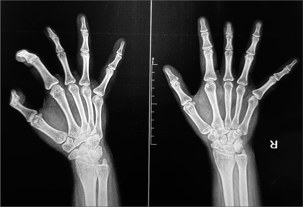 Radiographs of the right hand reveal well-formed proximal and interphalangeal joints of the middle finger. The metacarpal and phalanges appear hypoplastic and smaller compared to the adjacent fingers.