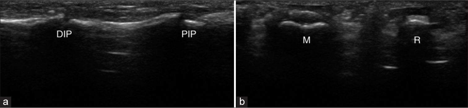 (a) Ultrasound shows the absence of flexor tendons (Flexor digitorum profundus, flexor digitorum superficialis) in the longitudinal view and well-formed distal interphalangeal joint and proximal interphalangeal joints. (b) Absent tendons and the presence of an empty tendon sheath are noted. DIP: Distal interphalangeal joint, PIP: Proximal interphalangeal joint.