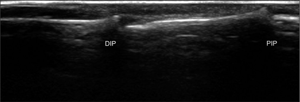 Ultrasound image demonstrating the absence of extensor tendons and the extensor mechanism in the middle finger. DIP: Distal interphalangeal joint, PIP: Proximal interphalangeal joint.