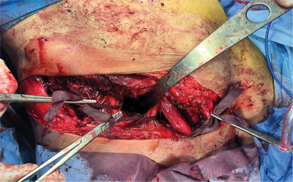 The middle window between the ileo-psoas muscle, with the femoral nerve laterally and the external iliac vessels medially.