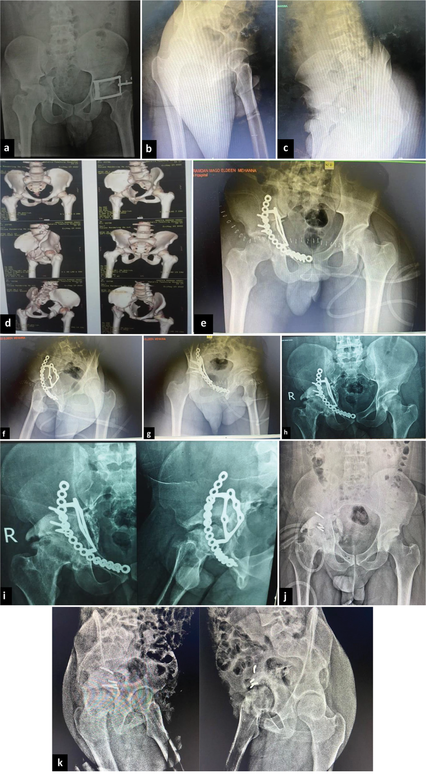 A 22-year-old male patient, after road traffic accident, (a-d) computed tomography image and pre-operative radiographs demonstrating acetabular transverse fracture, (e-g) post-operative radiographs showing fixation through ilioinguinal approach, (h and i) radiographs 12 months postoperatively, and (j and k) radiographs after removal of plate 14 months postoperatively due to infection.