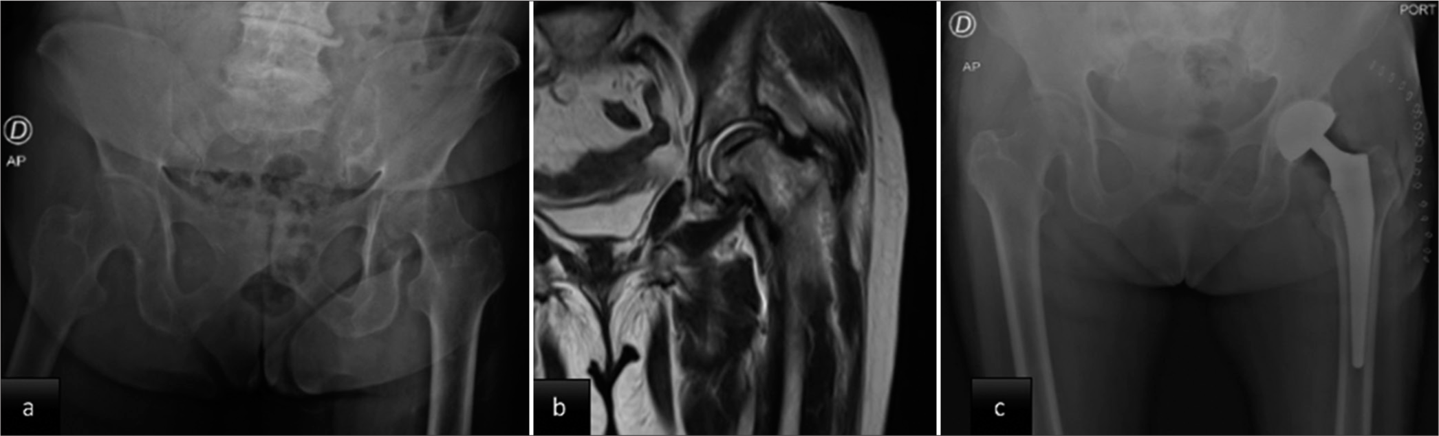 (a) Initial hip radiograph shows severe osteoarthritic changes with decreased joint space and a change in the shape of the femoral head. (b) Magnetic resonance imaging of the left hip: Decreased articular cartilage without evidence of bone tumor lesions. (c) Post-operative hip radiograph: cementless total hip prosthesis.