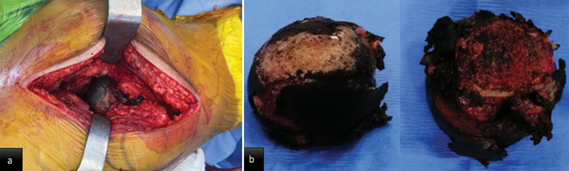 Intraoperative images: (a) Dark pigment in acetabular cartilage (b) dark pigment in the femoral head.