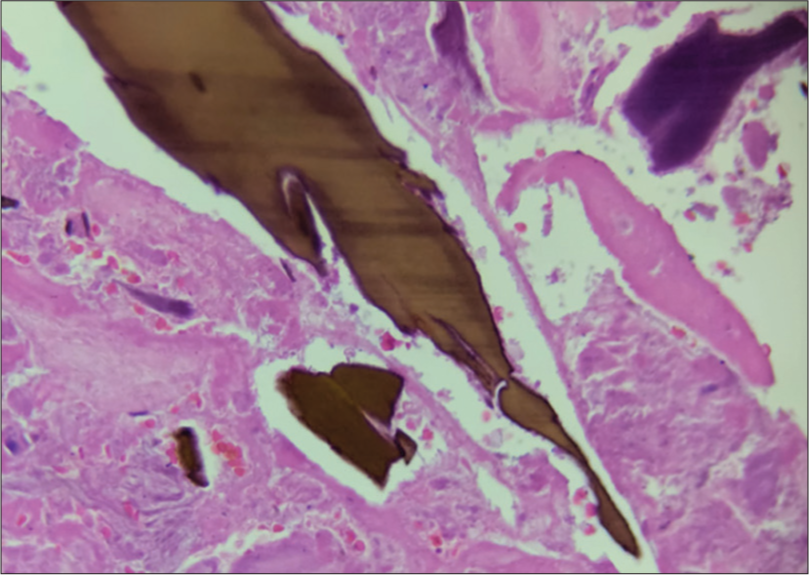 Microscopic findings: Ochronotic bodies deposit in the connective tissue yellow-brown in sickled shape.