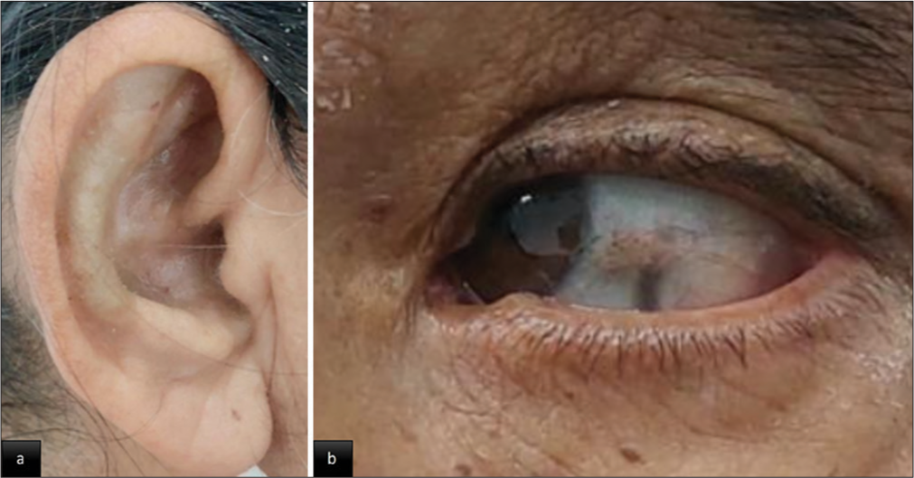 Clinical images with blue-black pigmentation in (a) antitragus of the ear. (b) Sclera of the left eye (Osler sign).