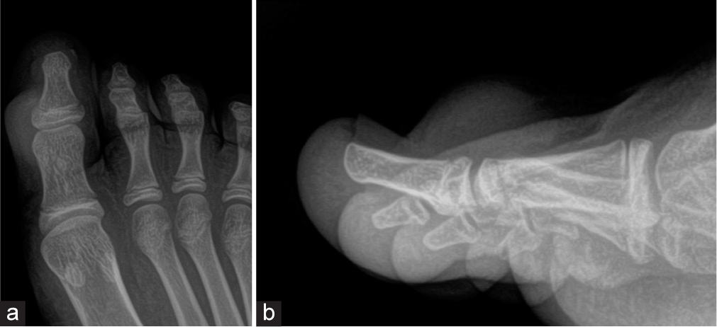 The radiograph of the foot shows (a, b) a soft-tissue lesion on the dorsum of the great toe without cortical involvement.