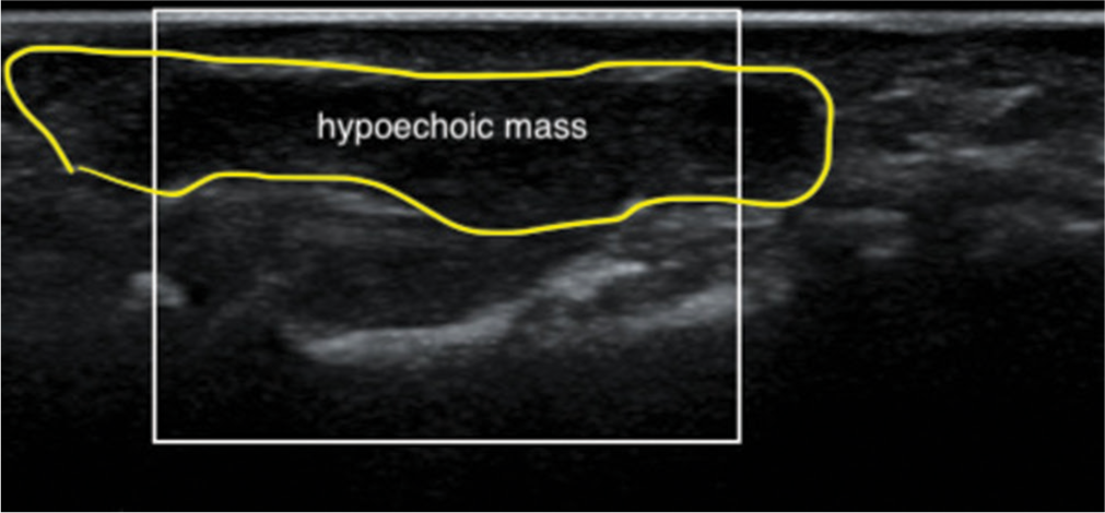 Ultrasound images of the finger at the middle phalanx level show a solid, homogeneous, hypoechoic mass immediately adjacent to the flexor tendons, suggesting Giant cell tumor of the tendon sheath.