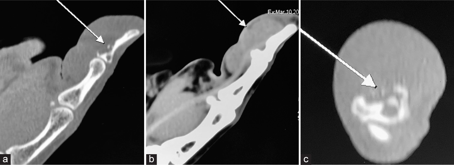 Computed tomography (CT) of the patient involving the interphalangeal joint of the thumb shows (a) osteolytic erosion in the distal phalanx near the flexor pollicis longus tendon attachment (white arrow), (b) solid hypodense mass with homogeneous enhancement on contrast-enhanced CT (white arrow), and (c) intra-osseous invasion in axial views (white arrow).