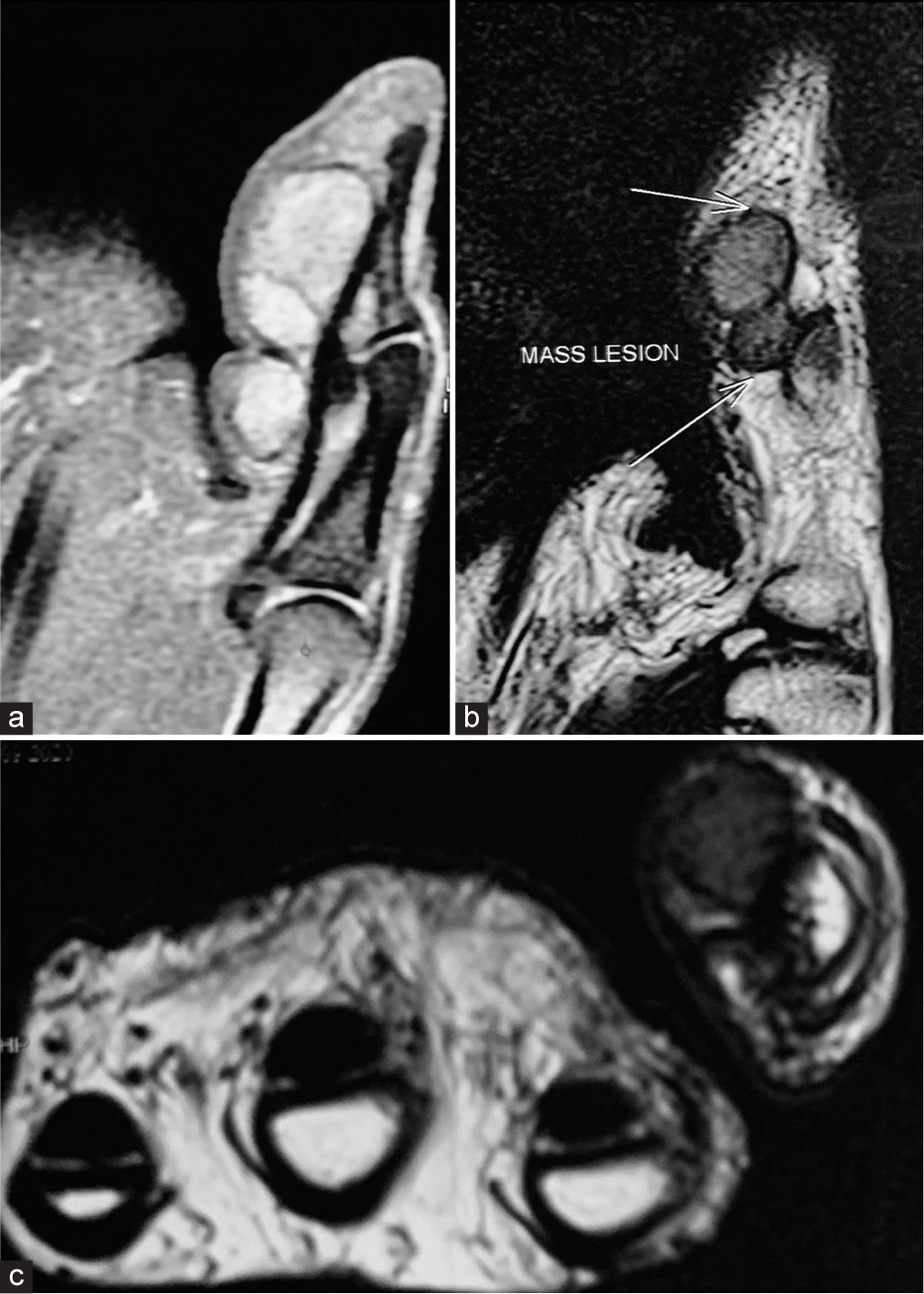 Sagittal (a and b) T1- and T2-weighted and axial (c) magnetic resonance imaging images demonstrate a large, lobulated soft-tissue mass occupying the volar aspect of the distal phalanx and interphalangeal joint, encasing the flexor pollicis longus tendon. In addition, the images reveal intraosseous invasion at the base of the distal phalanx.