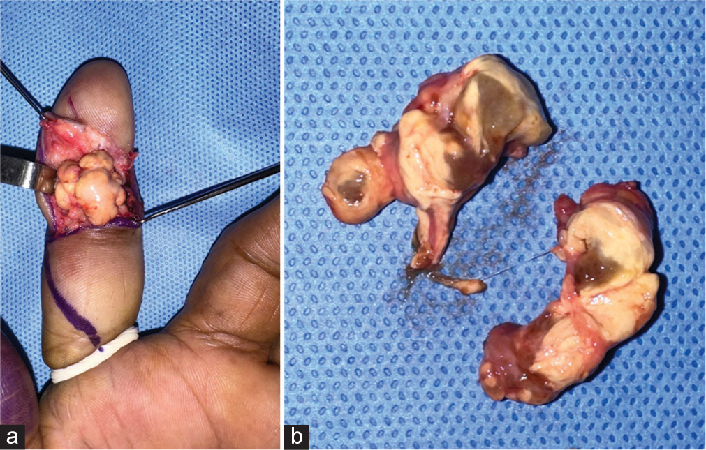 (a) Intraoperative picture of the large tumor in the volar aspect of the index finger. (b) The tumor is pedunculated, and the cut section shows multilobular, yellowish-brown due to the hemosiderin infiltration.