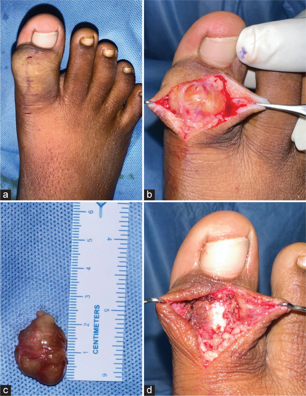 (a) The giant cell tumor of the tendon sheath was identified in an 11-year-old boy’s right great toe. (b) Macroscopically, the lesion appeared as a well-circumscribed, orange-yellow nodule with a firm consistency. (c) The lesion measured approximately 2.5 cm in size length. (d) Complete tumor excision is feasible and can yield good results.