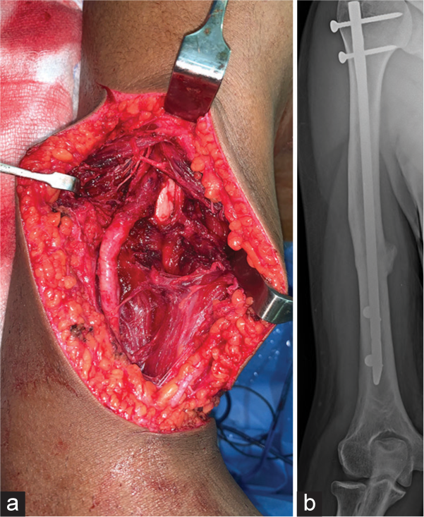 (a, b) The entrapped pattern of nerve injury is seen in the humerus fractures that appear thickened and contused at the entrapment site.