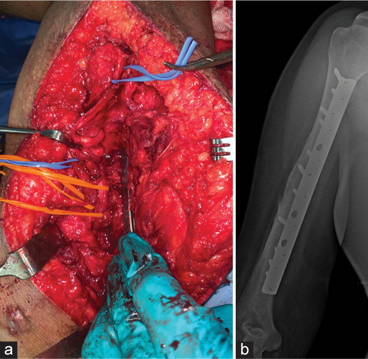 (a, b) The plate adhesion pattern of nerve injury is seen in the humerus fractures.