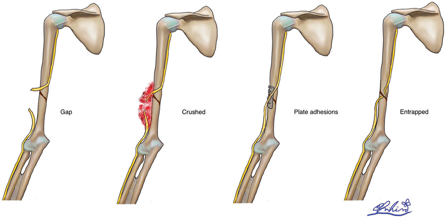 The illustration depicts the four different patterns of radial nerve injury seen in our study.