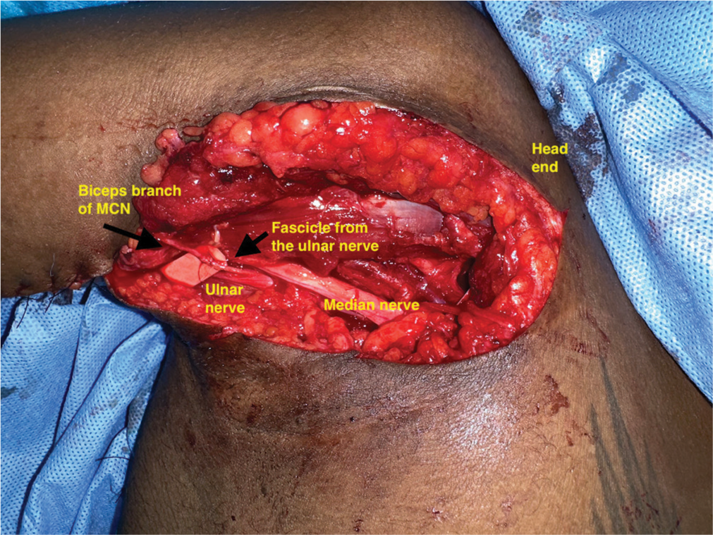 The intraoperative picture shows the ulnar fascicle transfer to the biceps branch of the musculocutaneous nerve.