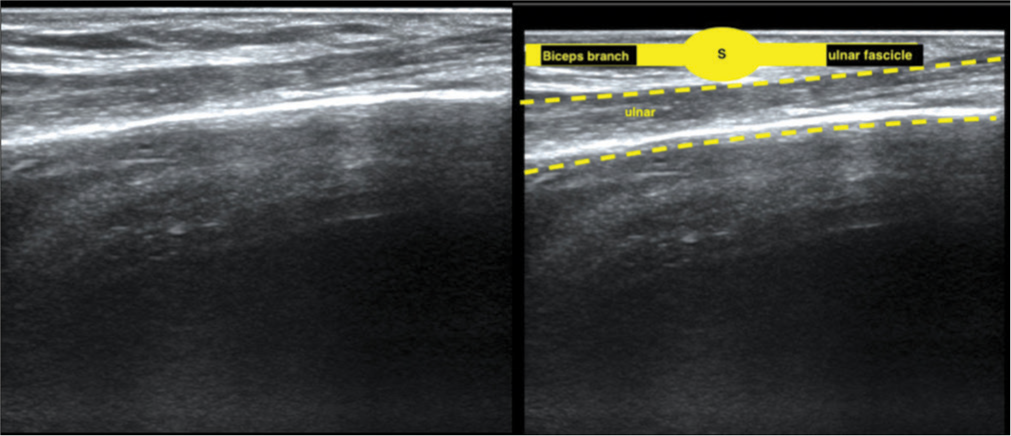 The ultrasound image of the same patient shows the normal fascicular pattern of the ulnar nerve, ulnar nerve fascicle (yellow), suture site (S), and the recipient nerve biceps branch of the musculocutaneous nerve.