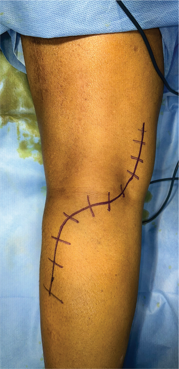 The skin incision over the posterior aspect of the knee.