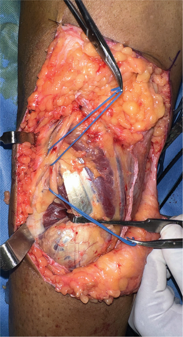 Intraoperative identification of the common peroneal nerve.