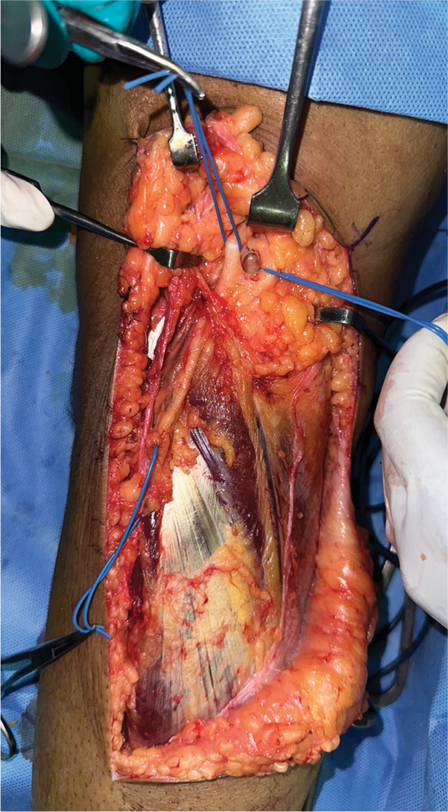 Proximal identification of the tibial nerve originating from the sciatic nerve during surgery.