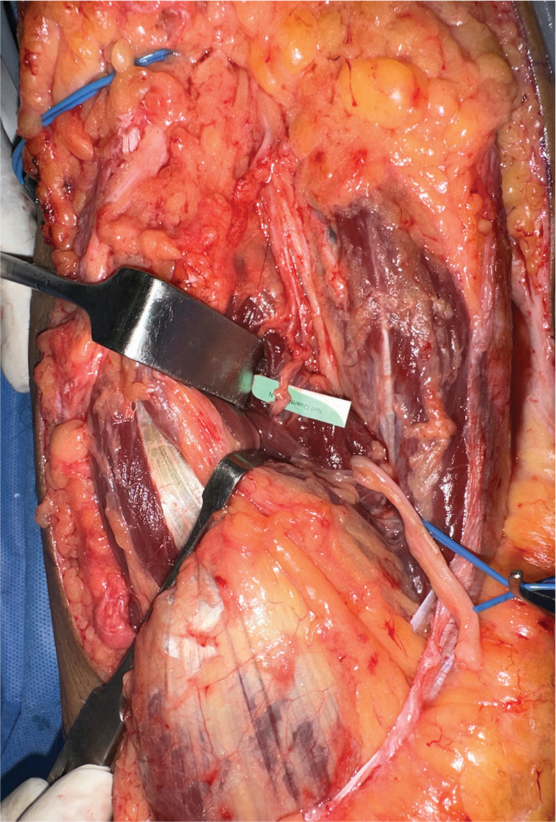 Intraoperative image of the lateral gastrocnemius nerve transfer to the deep peroneal nerve branch of the anterior tibial muscle.