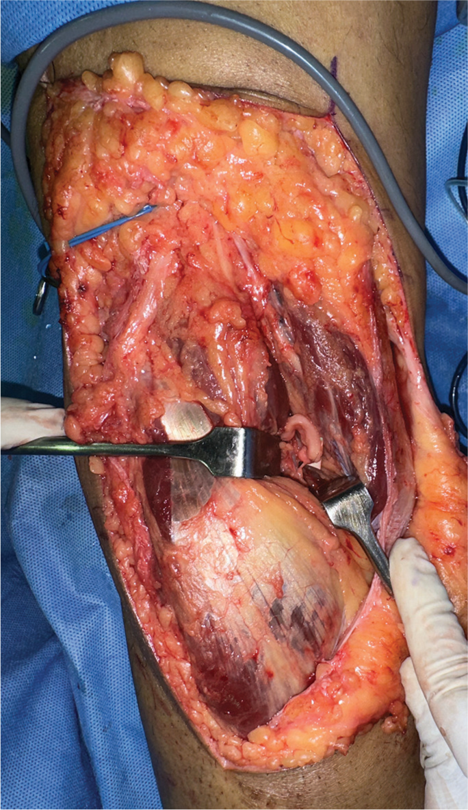 Intraoperative image of the flexor hallucis longus branch of the tibial nerve being transferred to the superficial peroneal nerve.