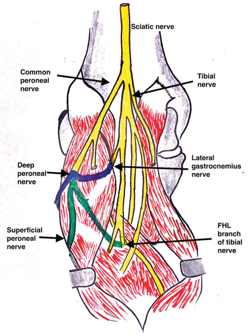 Illustrative diagram of the distal nerve transfers for foot drop. Blue: Transfer of the deep peroneal branch of the anterior tibial muscle to the lateral gastrocnemius nerve branch. Green: Transfer of the superficial peroneal nerve branch to the flexor hallucis longus branch of the tibial nerve.